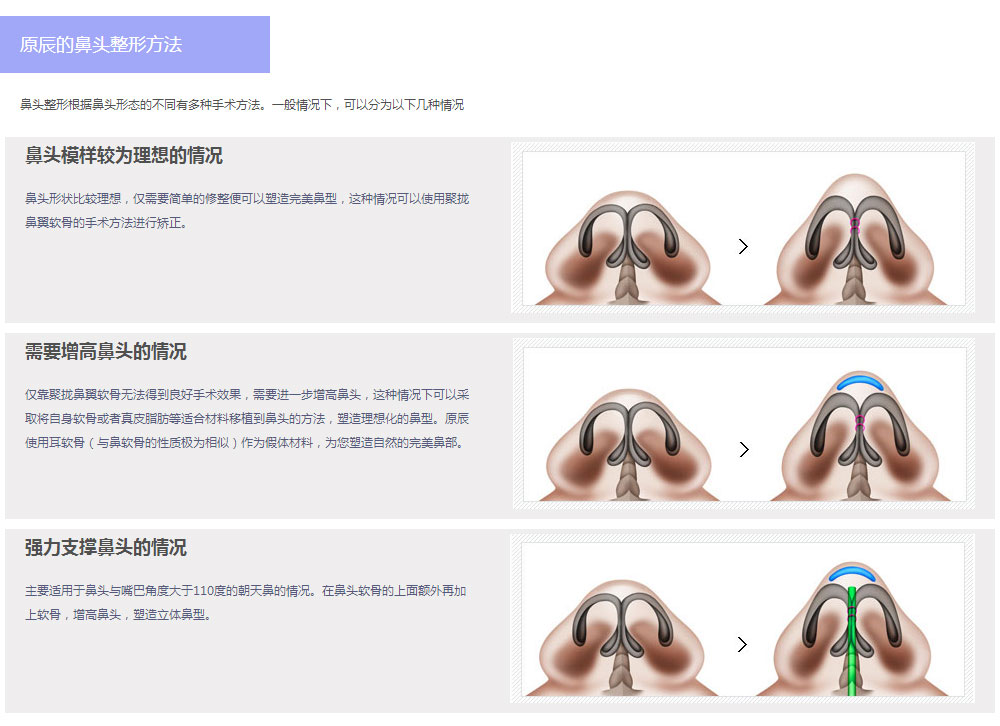 韩国原辰鼻形矫正