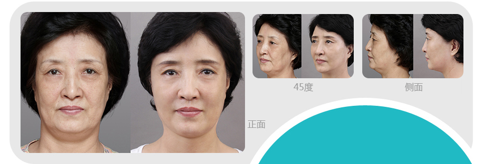 韩国原辰祛眼袋手术