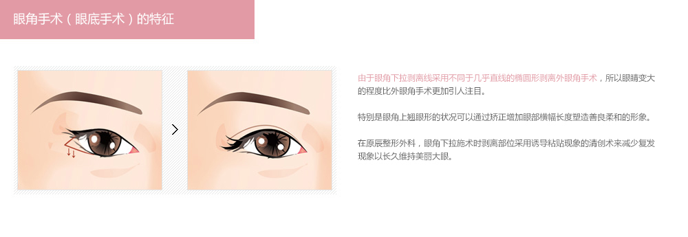 韩式开外眼角手术需要多少钱