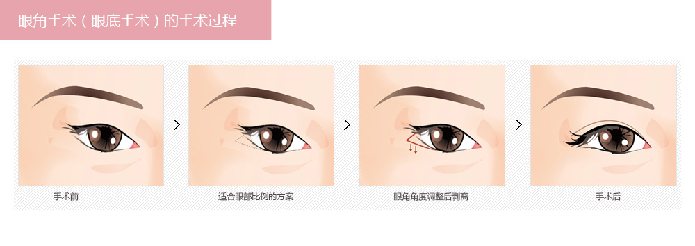 开外眼角一般需要多少钱