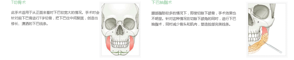 韩国下颌角整形医院排名榜