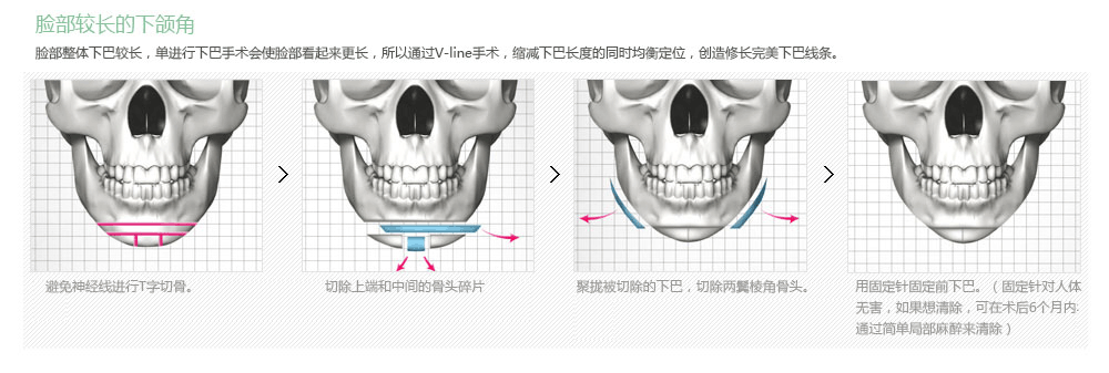 韩国下颌角整形有哪些优势