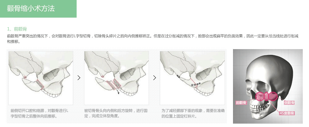 韩国颧骨整形适合哪些人
