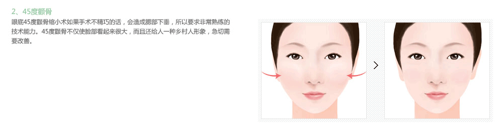 韩国颧骨整形适合哪些人
