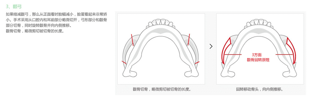 韩国颧骨整形适合哪些人