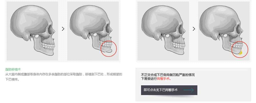 韩国下巴整形哪里效果好
