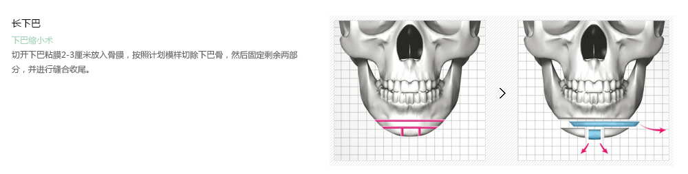韩国下巴整形哪里效果好