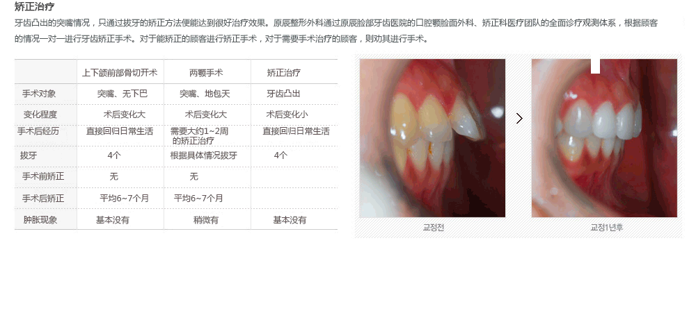 韩国突嘴手术医院哪家好