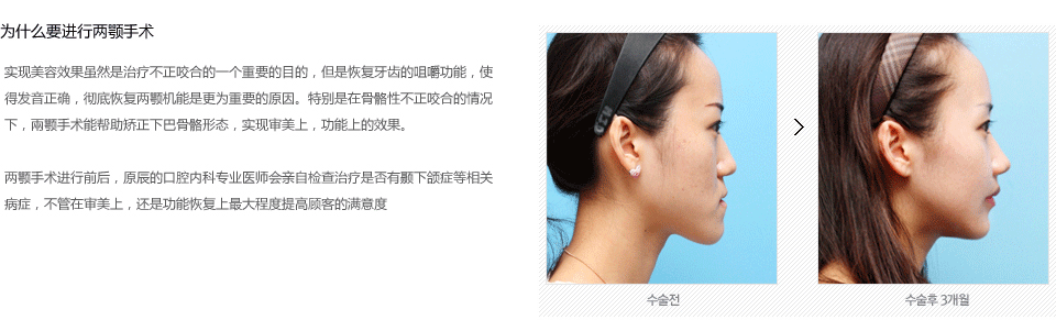 韩国两鄂手术多少钱