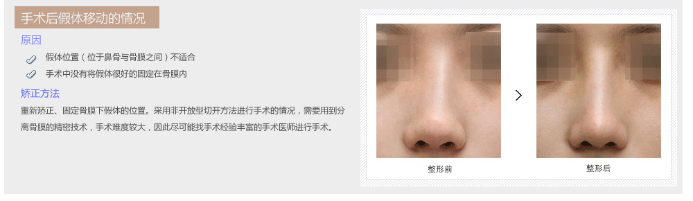 韩国鼻部整形修复医院哪个好
