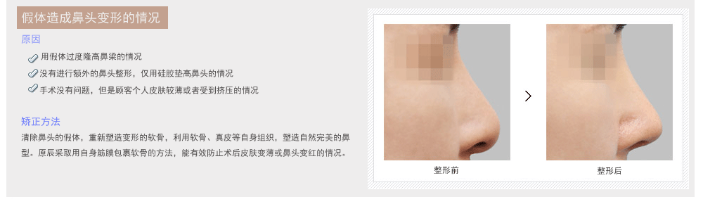 韩国鼻部整形修复哪个医院好
