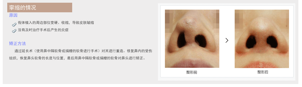 韩国鼻部修复手术的费用