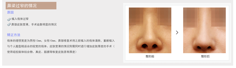 韩国哪家医院鼻部整形修复好