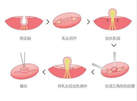 韩国乳头整形