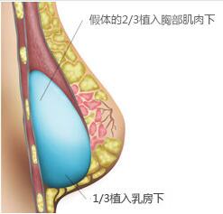 韩国隆胸