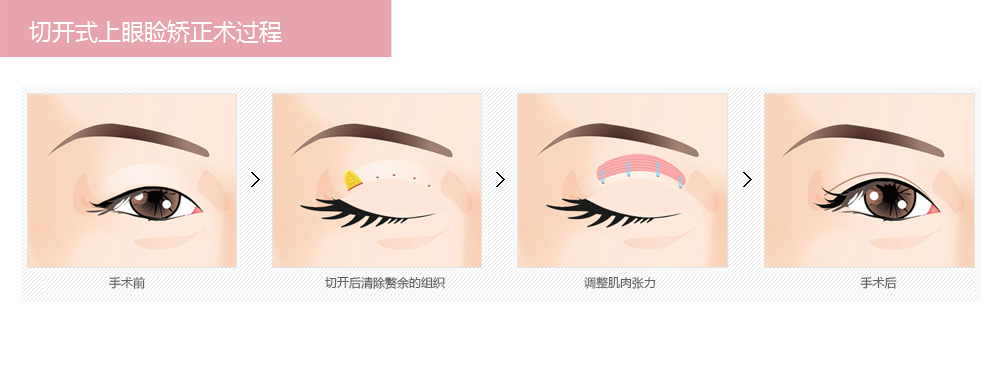 切开式上眼睑矫正术价格