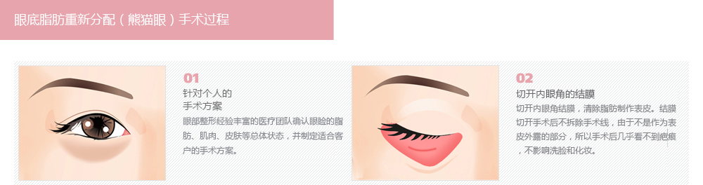 手术去除黑眼圈价钱