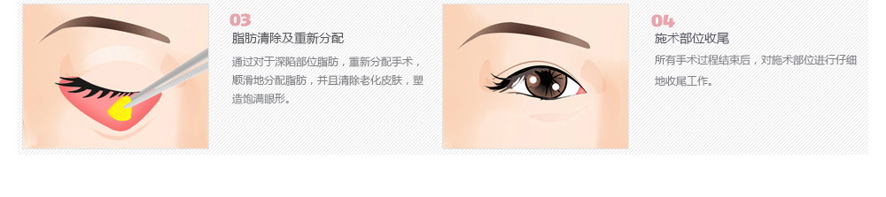 手术去除黑眼圈价钱