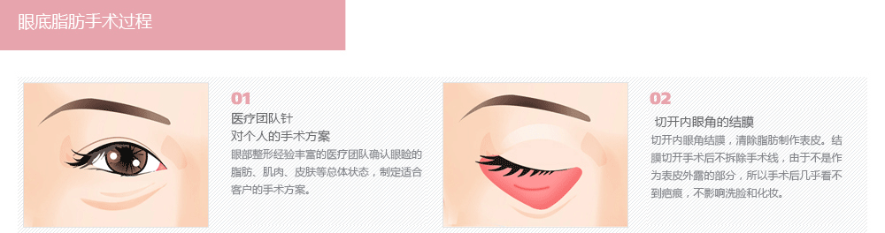 韩式眼底脂肪去除