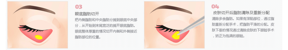 韩式眼底脂肪去除