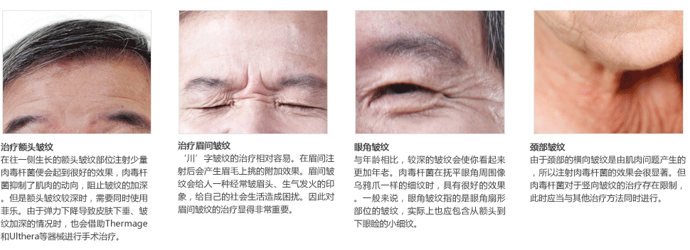 肉毒素价格