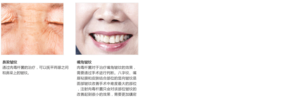 肉毒素价格