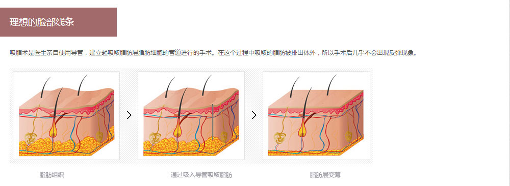 吸脂减肥