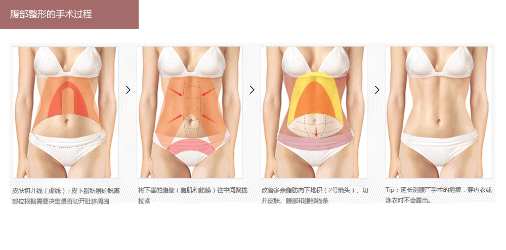 韩国腹部吸脂哪个医院好