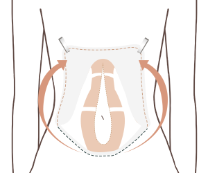 腹部整形