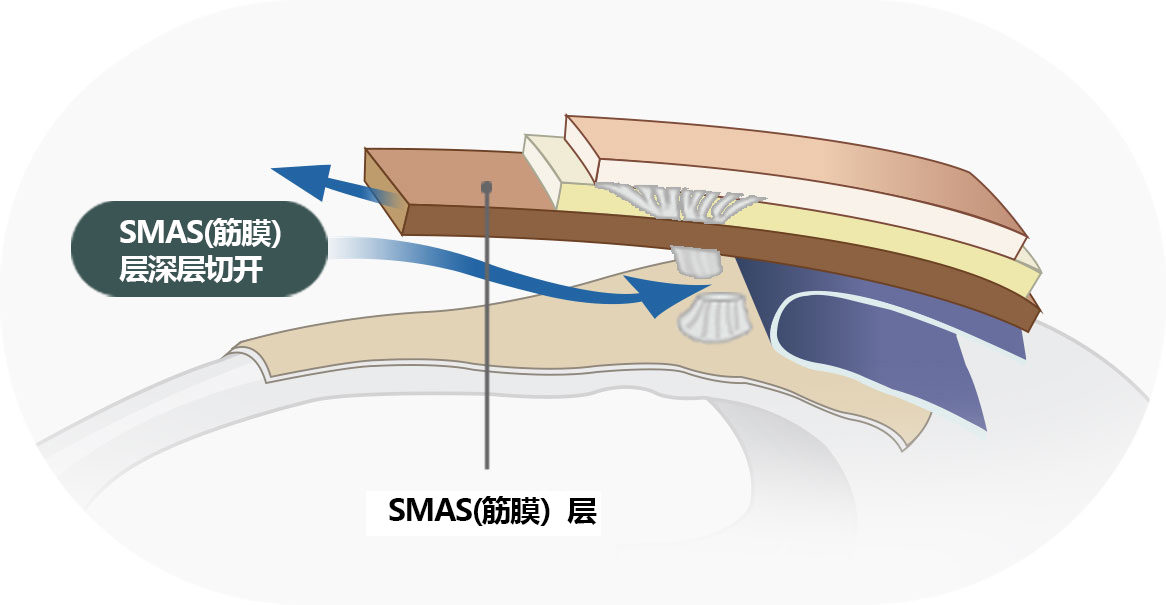 SMAS(ĤWJԭ