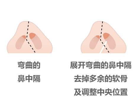 展开弯曲的中隔软骨/中隔,去除剩余软骨并中央放置照片