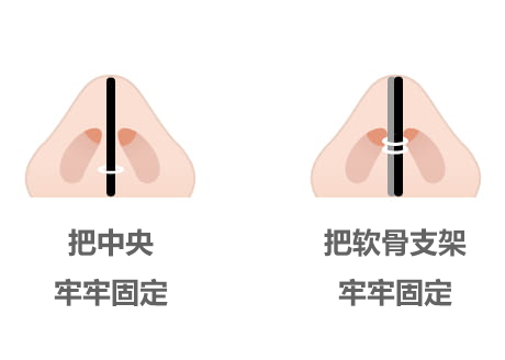 加固中央/加固软骨支架的照片